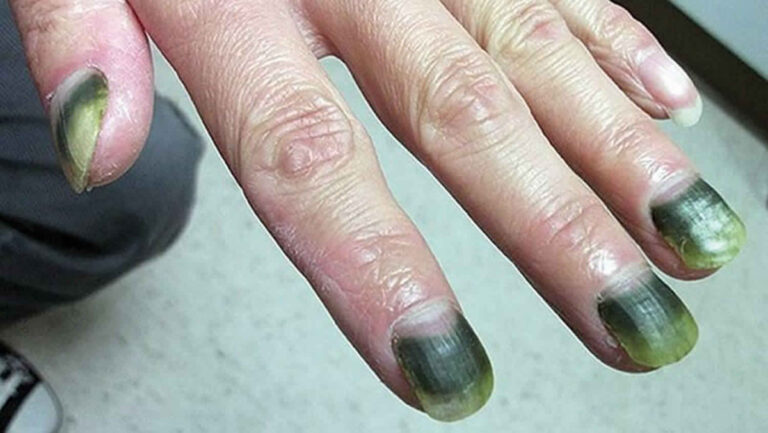 Entenda a Síndrome das unhas Verdes e a Cura